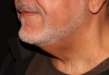 CoolSculpting® Treatment Before - Paramus, NJ CoolSculpting® Treatment Before - Paramus, NJ
