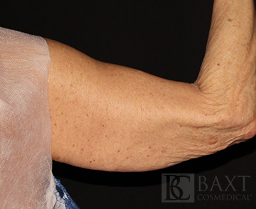 CoolSculpting® Treatment Before - Paramus, NJ CoolSculpting® Treatment Before - Paramus, NJ