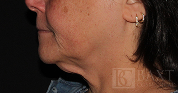 CoolSculpting® Treatment Before - Paramus, NJ CoolSculpting® Treatment Before - Paramus, NJ