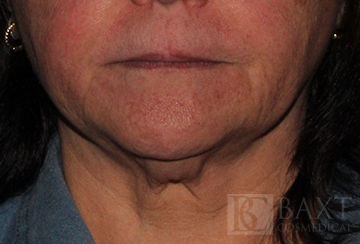 CoolSculpting® Treatment Before - Paramus, NJ CoolSculpting® Treatment Before - Paramus, NJ