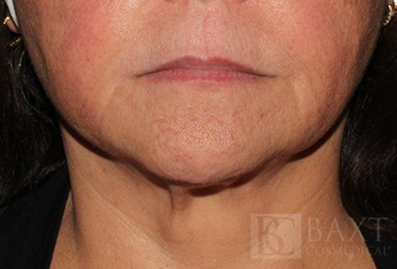 CoolSculpting® Treatment After - Paramus, NJ CoolSculpting® Treatment After - Paramus, NJ