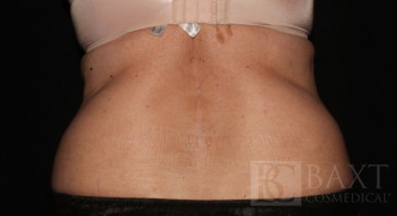 CoolSculpting® Treatment Before - Paramus, NJ CoolSculpting® Treatment Before - Paramus, NJ