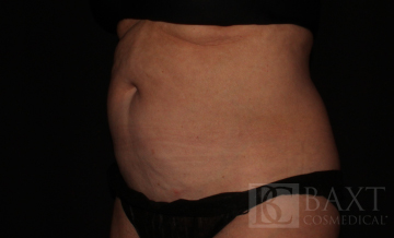 CoolSculpting® Treatment After - Paramus, NJ CoolSculpting® Treatment After - Paramus, NJ