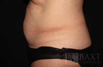 CoolSculpting® Treatment Before - Paramus, NJ CoolSculpting® Treatment Before - Paramus, NJ