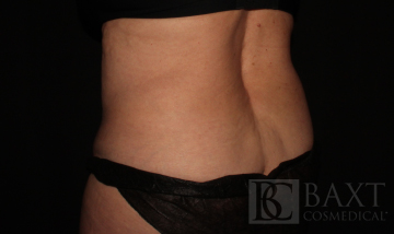CoolSculpting® Treatment After - Paramus, NJ CoolSculpting® Treatment After - Paramus, NJ