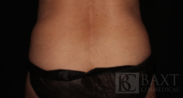 CoolSculpting® Treatment After - Paramus, NJ CoolSculpting® Treatment After - Paramus, NJ