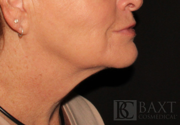 CoolSculpting® Treatment After - Paramus, NJ CoolSculpting® Treatment After - Paramus, NJ