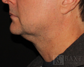 CoolSculpting® Treatment Before - Paramus, NJ CoolSculpting® Treatment Before - Paramus, NJ