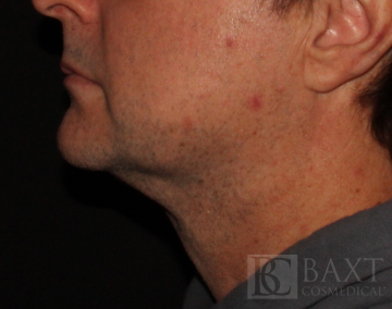 CoolSculpting® Treatment After - Paramus, NJ CoolSculpting® Treatment After - Paramus, NJ
