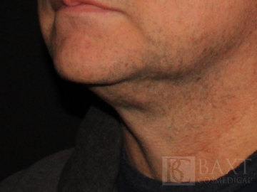 CoolSculpting® Treatment Before - Paramus, NJ CoolSculpting® Treatment Before - Paramus, NJ