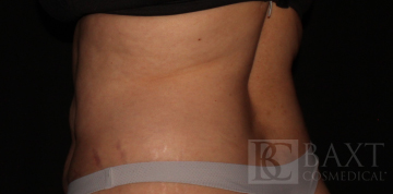 CoolSculpting® Treatment After - Paramus, NJ