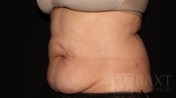 CoolSculpting® Treatment Before - Paramus, NJ
