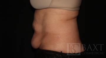 CoolSculpting® Treatment Before - Paramus, NJ