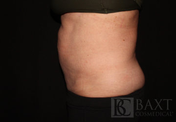 CoolSculpting® Treatment Before - Paramus, NJ