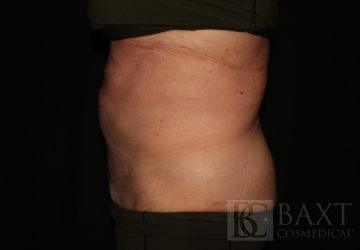CoolSculpting® Treatment After - Paramus, NJ