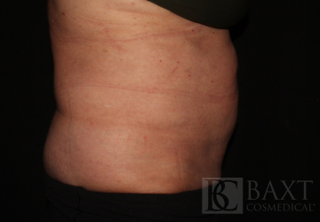 CoolSculpting® Treatment Before - Paramus, NJ