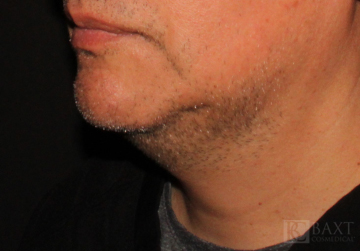 CoolSculpting® Treatment Before - Paramus, NJ