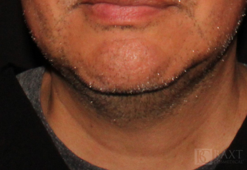 CoolSculpting® Treatment Before - Paramus, NJ