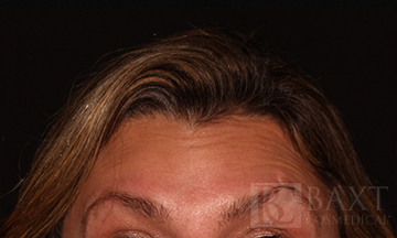 Closeup of patient Before Daxxify® Treatment