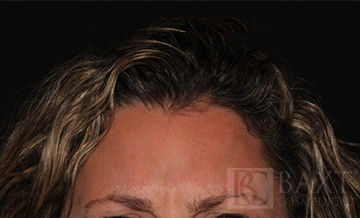 DAXXIFY™ Treatment After - Paramus, NJ DAXXIFY™ Treatment After - Paramus, NJ