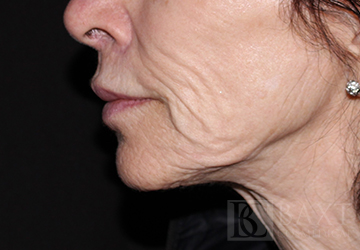 A patient's lower face area before ellacor®