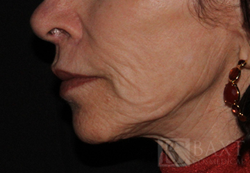 A patient's lower face area after ellacor®