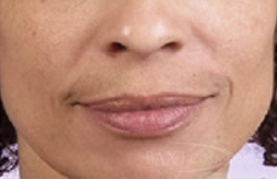 Fillers Before - Paramus, NJ