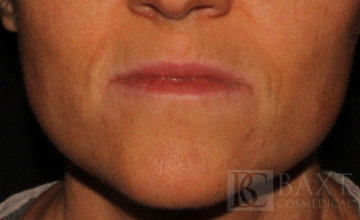 Fillers Before - Paramus, NJ