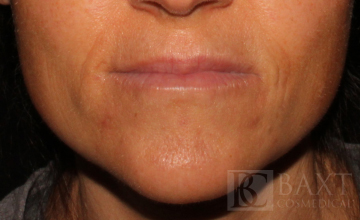 Fillers After - Paramus, NJ
