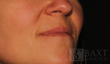 Fillers Before - Paramus, NJ