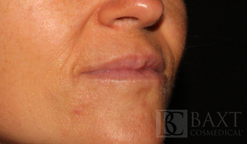 Fillers After - Paramus, NJ