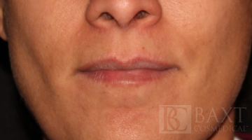 Fillers Before - Paramus, NJ