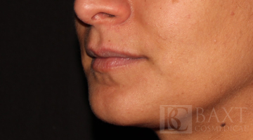 Fillers Before - Paramus, NJ