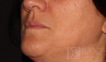 Fillers Before - Paramus, NJ Fillers Before - Paramus, NJ