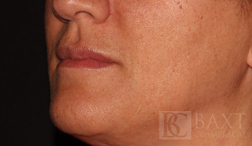 Fillers After - Paramus, NJ Fillers After - Paramus, NJ