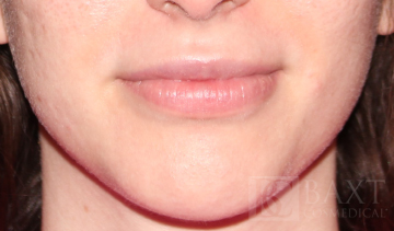 Fillers After - Paramus, NJ