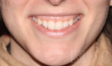 Fillers Before - Paramus, NJ