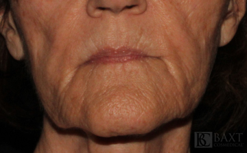 Fillers Before - Paramus, NJ Fillers Before - Paramus, NJ