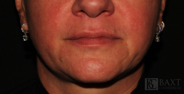 Fillers Before - Paramus, NJ