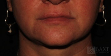 Fillers After - Paramus, NJ