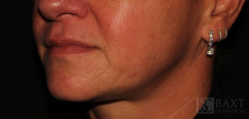 Fillers Before - Paramus, NJ