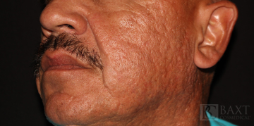 Fillers Before - Paramus, NJ Fillers Before - Paramus, NJ