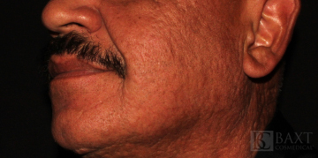 Fillers After - Paramus, NJ Fillers After - Paramus, NJ