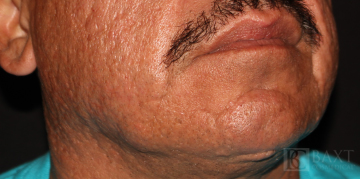 Fillers Before - Paramus, NJ Fillers Before - Paramus, NJ