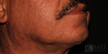Fillers After - Paramus, NJ Fillers After - Paramus, NJ