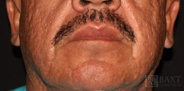 Fillers Before - Paramus, NJ Fillers Before - Paramus, NJ