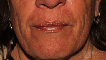 Fillers Before - Paramus, NJ