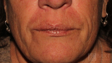 Fillers After - Paramus, NJ