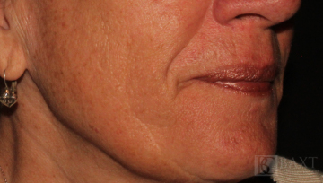 Fillers Before - Paramus, NJ
