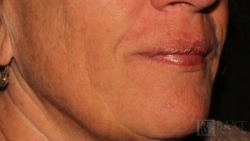 Fillers After - Paramus, NJ